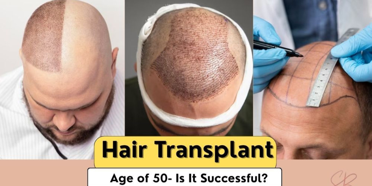 Is Hair Transplant Effective After 50? What You Need to Know